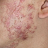 Scars from Acne or Self-Harm