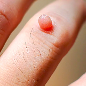 black warts on hands