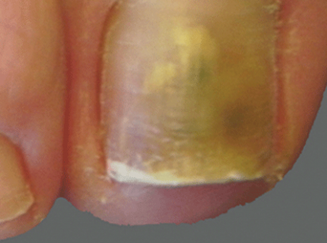 Types of Toenail Fungus Pictures Symptoms and Treatment